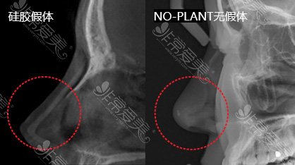 韩国GNG自体软骨隆鼻后CT也看不到