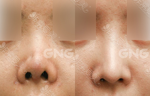 韩国GNG整形自体软骨隆鼻修复朝天鼻