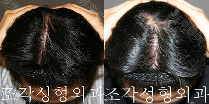韩国雕刻整形医院男性后脑勺不凹凸不平填充案例