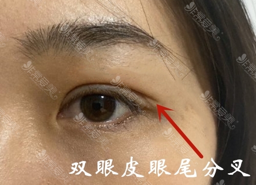 双眼皮术后分叉原因是什么能长好吗?韩国眼尾分叉怎么修复