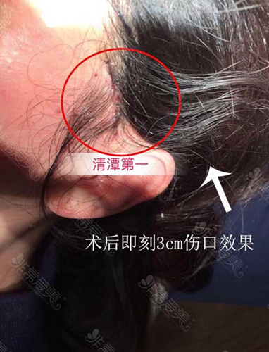 韩国清潭first医院提升手术实拍 韩国清潭first医院提升手术实拍
