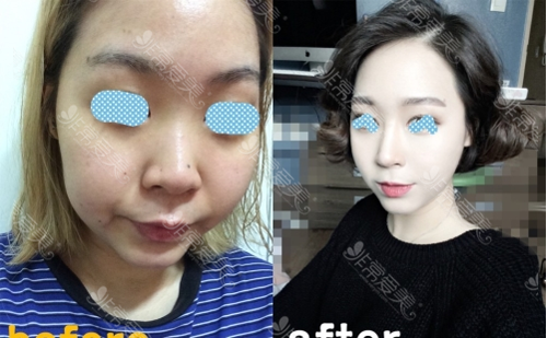 韩国高诺鼻整形外科鼻修复案例