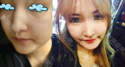 韩国高诺鼻整形外科鼻修复前后图