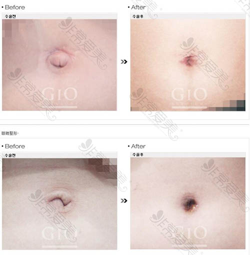 韩国GIO医院肚脐整形前后对比案例