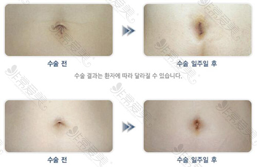 韩国美脐手术前后对比照片