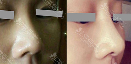 韩国WILL整形外科鼻基底填充日记
