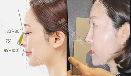 韩国WILL整形外科鼻整形合适角度