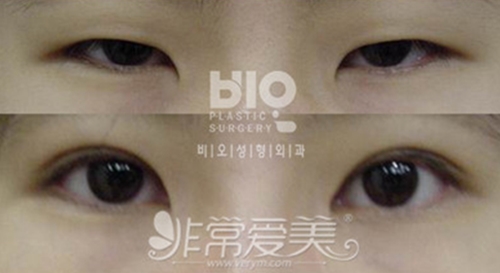 韩国BIO曹仁昌内双双眼皮手术图片