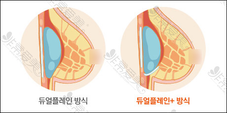 韩国普罗菲耳隆胸假体植入对比