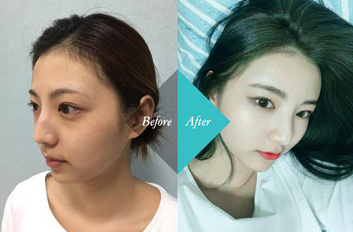 韩国美艺整形外科隆鼻前后对比照