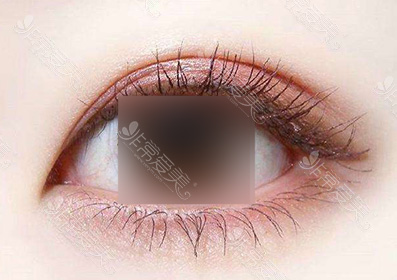 韩国修复双眼皮名医解答：埋线双眼皮变成三眼皮怎么恢复