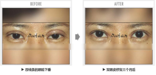 韩国枓翰医院双眼皮修复真人案例