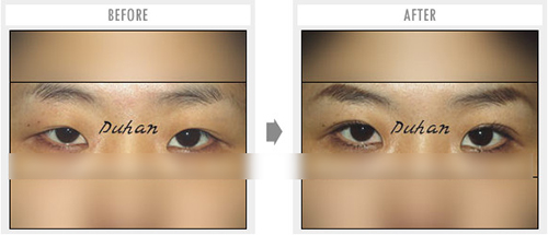 韩国枓翰整形外科双眼皮手术对比案例