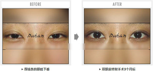 韩国枓翰双眼皮修复案例
