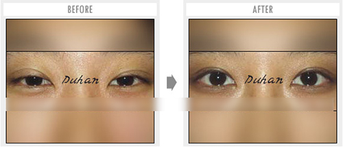 韩国枓翰整形外科眼部修复对比案例