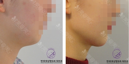 韩国延世YB整形双下巴吸脂前后对比图