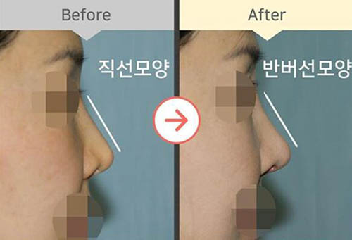 韩国Flora整形外科隆鼻对比图