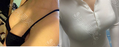 韩国MD整形隆胸效果图示