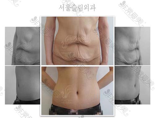 首尔slim外科腰腹赘皮修复真人案例