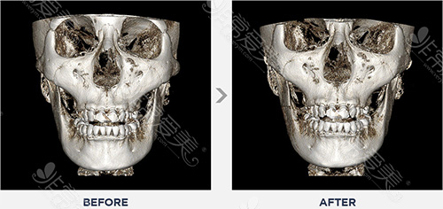韩国美迪莹无金属面部轮廓颧骨缩小对比