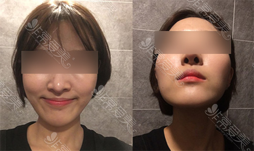 韩国美迪莹面部轮廓不用钛钉固定效果好吗？会不会下垂？