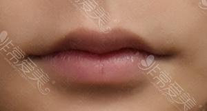 哪种唇适合做微笑唇？韩国哪里做嘴唇整形效果好？