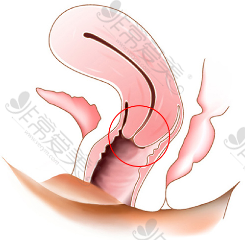 阴道松弛引起的子宫下垂图示