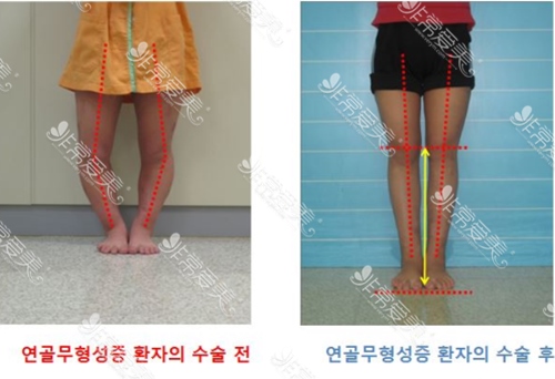 韩国rapha医院成年o型腿矫正手术日记