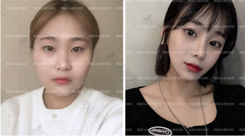 韩国DA整形外科面部轮廓案例对比