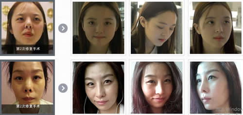 韩国4月31日整形外科鼻修复真人对比