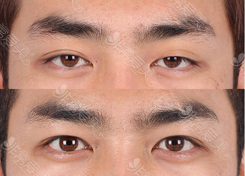 韩国哪家双眼皮修复效果好？当地人喜欢去这家宝藏医院