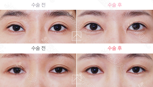 韩国Misoline整形修复双眼皮