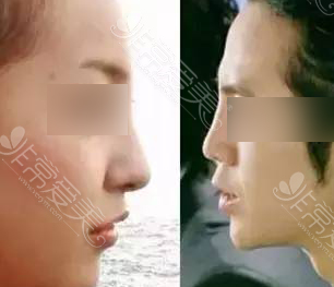韩国隆鼻效果更自然吗？为什么有的人鼻整形看起来却很假