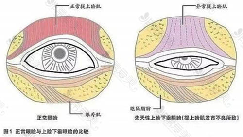 韩国双眼皮手术一般8000能做吗？多少钱能做双眼皮+眼提肌？