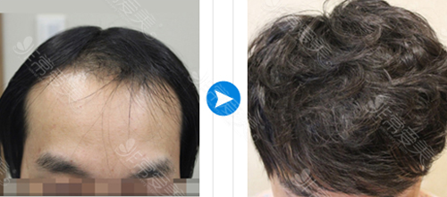 韩国JP医院毛发移植前后对比
