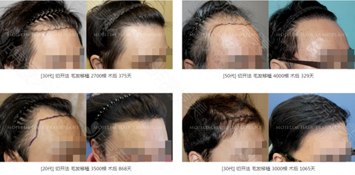 韩国哪家植发医院比较好，好在哪些细节？韩国植发可靠吗?