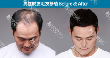 韩国植发经历分享，告诉你植发恢复需要注意的几个细节