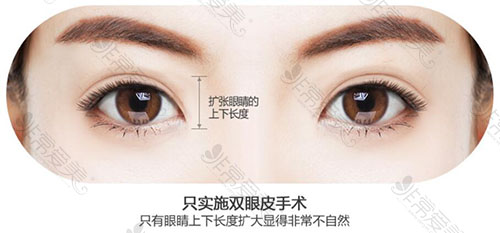 韩国普瑞美整形外科双眼皮整形方法