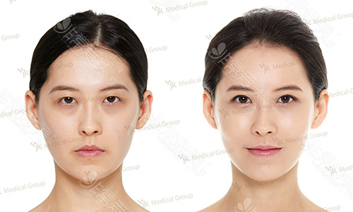 面部提升激光疗法对比图