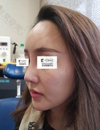 韩国清新整形外科朝天鼻修复术后效果