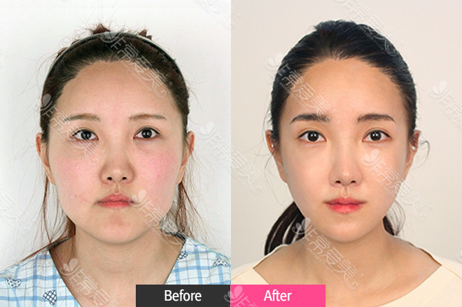 韩国faceline面部吸脂案例