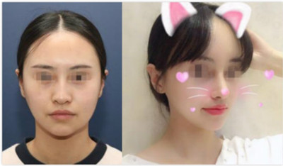 韩国nano整形外科隆鼻风格