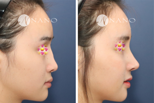 韩国nano整形外科隆鼻案例图