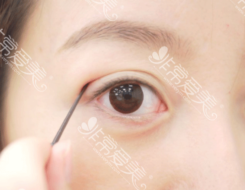 韩国双眼皮分为几种类型？ 手术方式和优缺点都有哪些？