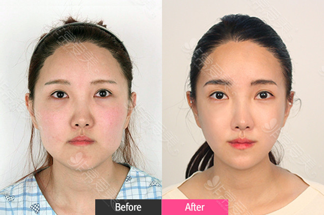 瘦脸只有打瘦脸吗？韩国轮廓三件套手术还不错！