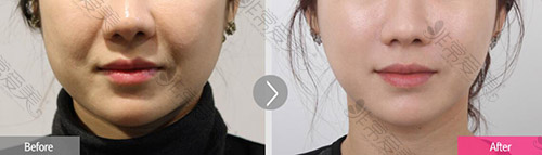 瘦脸只有打瘦脸针吗？韩国轮廓三件套手术还不错！