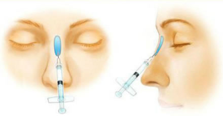 韩国隆鼻手术有几种材料，优缺点分别是什么？