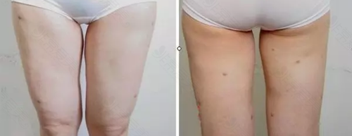 韩国大腿抽脂针眼3个常见位置科普:屁股、内裤线及这个位置
