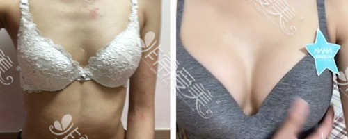韩国NANA整形外科黄铜渊院长隆胸前后对比
