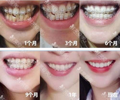 韩国齐娥牙科医院女生带牙套1~12月变化图